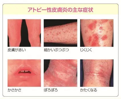 アトピー性皮膚炎 - 南都留郡富士河口湖町の皮膚科 河口湖さおり皮ふ科